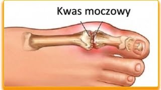 Owoce obniżające poziom kwasu moczowego we krwi [upl. by Hourigan]