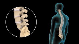 Lesiones de disco lumbar y tratamiento [upl. by Simah116]