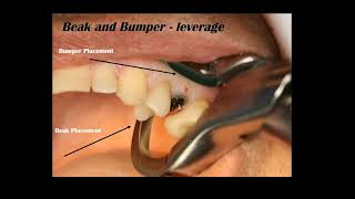 Physics Forceps Atraumatic Extraction Technique  GoldenDent [upl. by Leribag511]